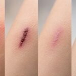 How Does the Body Heal a Wound Key Stages Explained