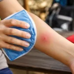 Red Wasp Sting What to Do & When to Seek Help