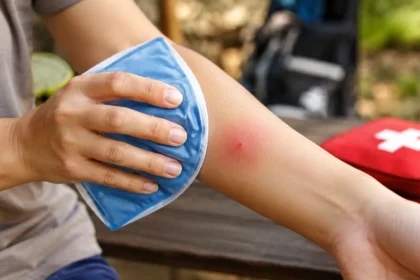 Red Wasp Sting What to Do & When to Seek Help